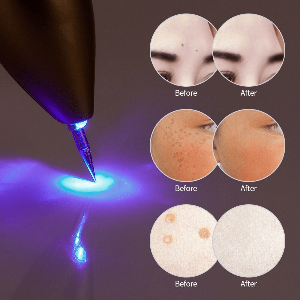 You Can Actually Buy This 1-Million Watt Laser Tattoo Remover Online -  TechEBlog