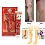 100% Original Veins Varicose Treatment Plaster Treatment...